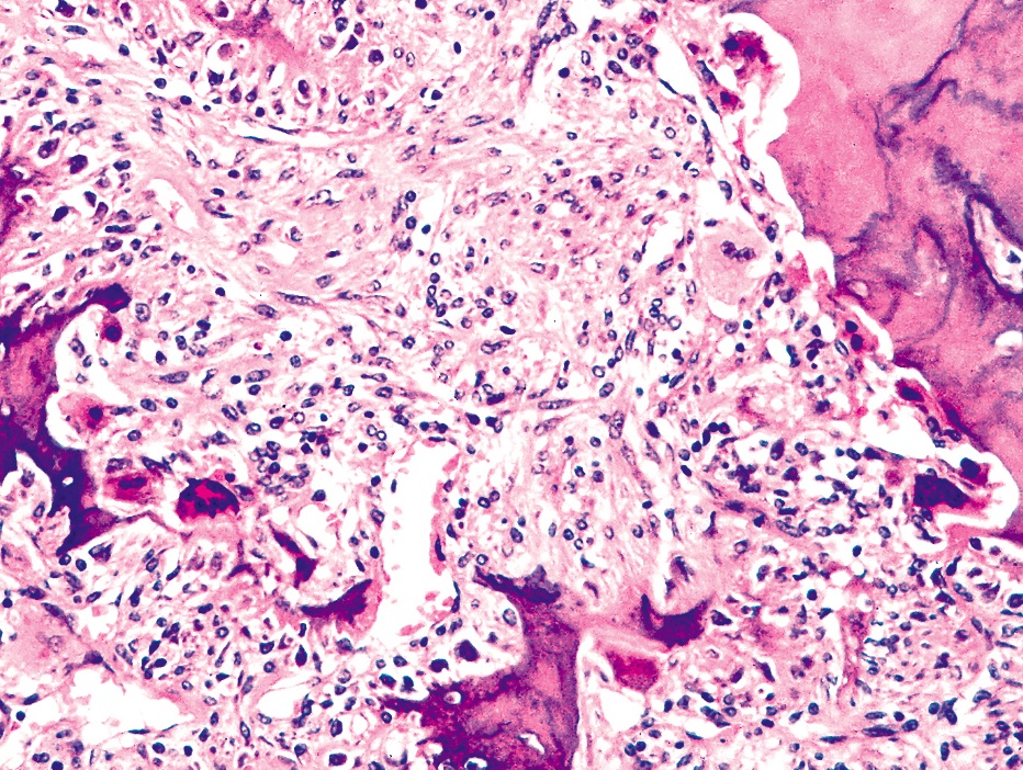 Pathology Outlines Paget disease associated